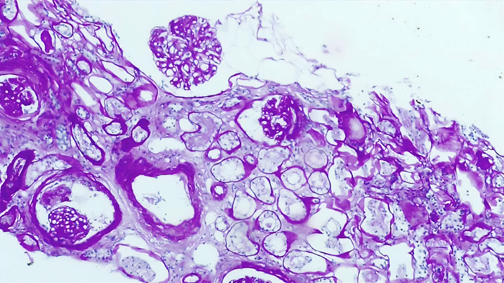 Una imagen histopatológica tomada con microscopio a una muestra de sangre de un paciente con nefritis. Una imagen histopatológica tomada con microscopio a una muestra de sangre de un paciente con nefritis.